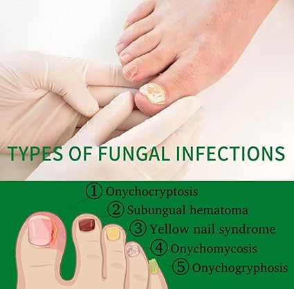 7 Days Nail Fungal Treatment Essence Oil Foot Toe Nail Fungus Removal Serum