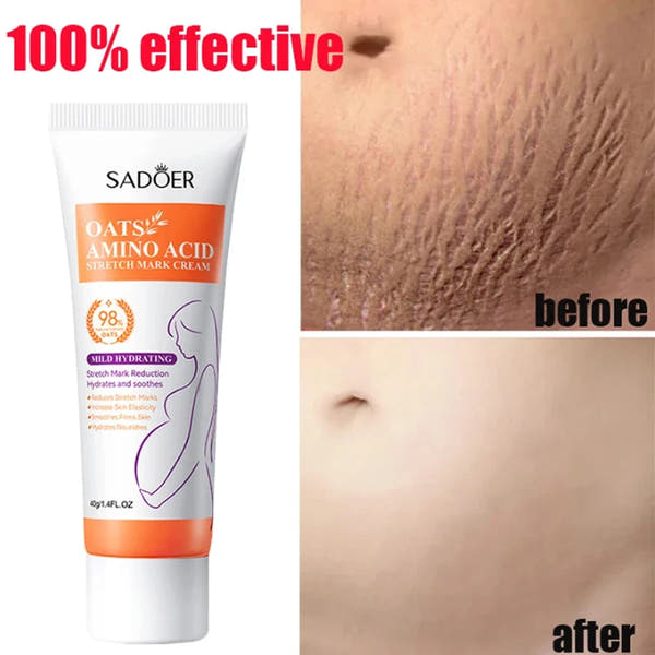 Stretch Mark Repair Cream – Permanent Removal & Firming