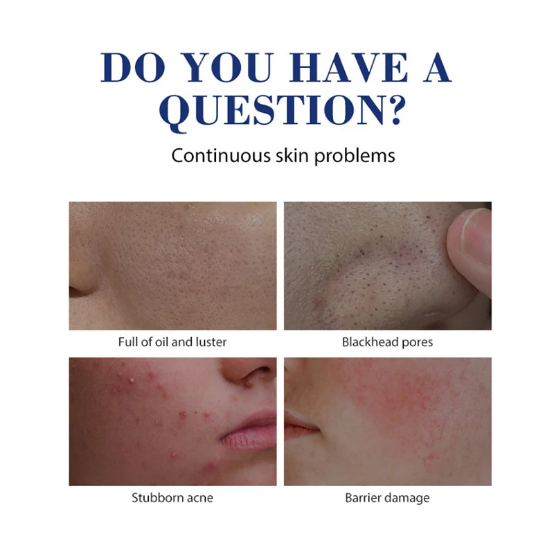 Salicylic Acid Acne Cream – Clear, Soothe & Repair Skin