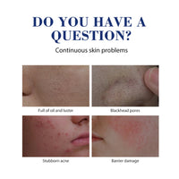 Salicylic Acid Acne Cream – Clear, Soothe & Repair Skin