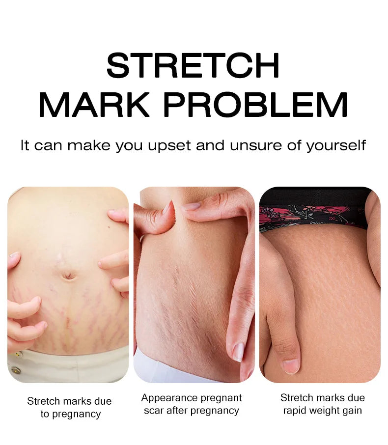 Stretch Mark Removal Cream – Repair & Firm Skin (50g)