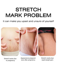 Stretch Mark Removal Cream – Repair & Firm Skin (50g)
