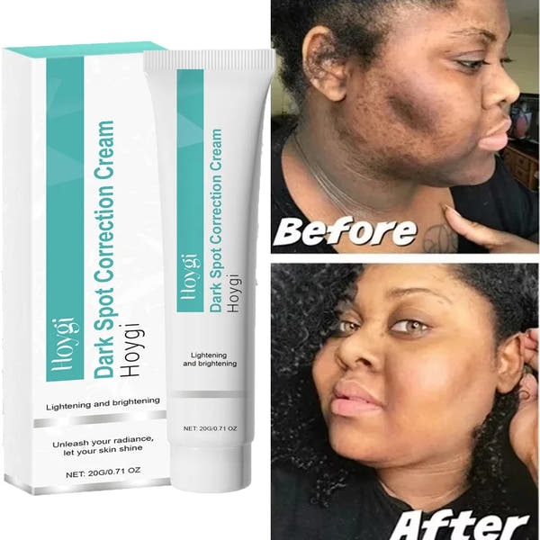Dark Spot Remover & Whitening Cream – Brighten & Even Skin