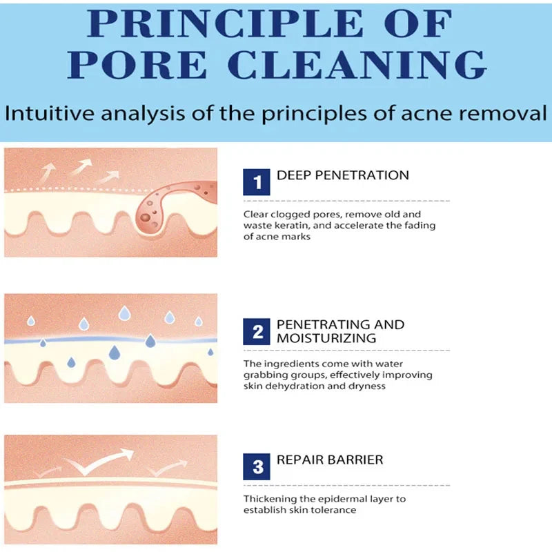 Salicylic Acid Acne Cream – Clear, Soothe & Repair Skin