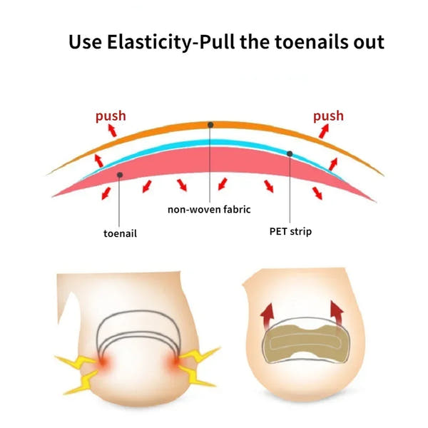 50/100pcs Nail Correction Stickers Ingrown Toenail Corrector Patches Paronychia Treatment Recover Corrector Pedicure Tools