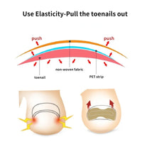 50/100pcs Nail Correction Stickers Ingrown Toenail Corrector Patches Paronychia Treatment Recover Corrector Pedicure Tools