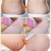 Stretch Mark Repair Cream – Permanent Removal & Firming