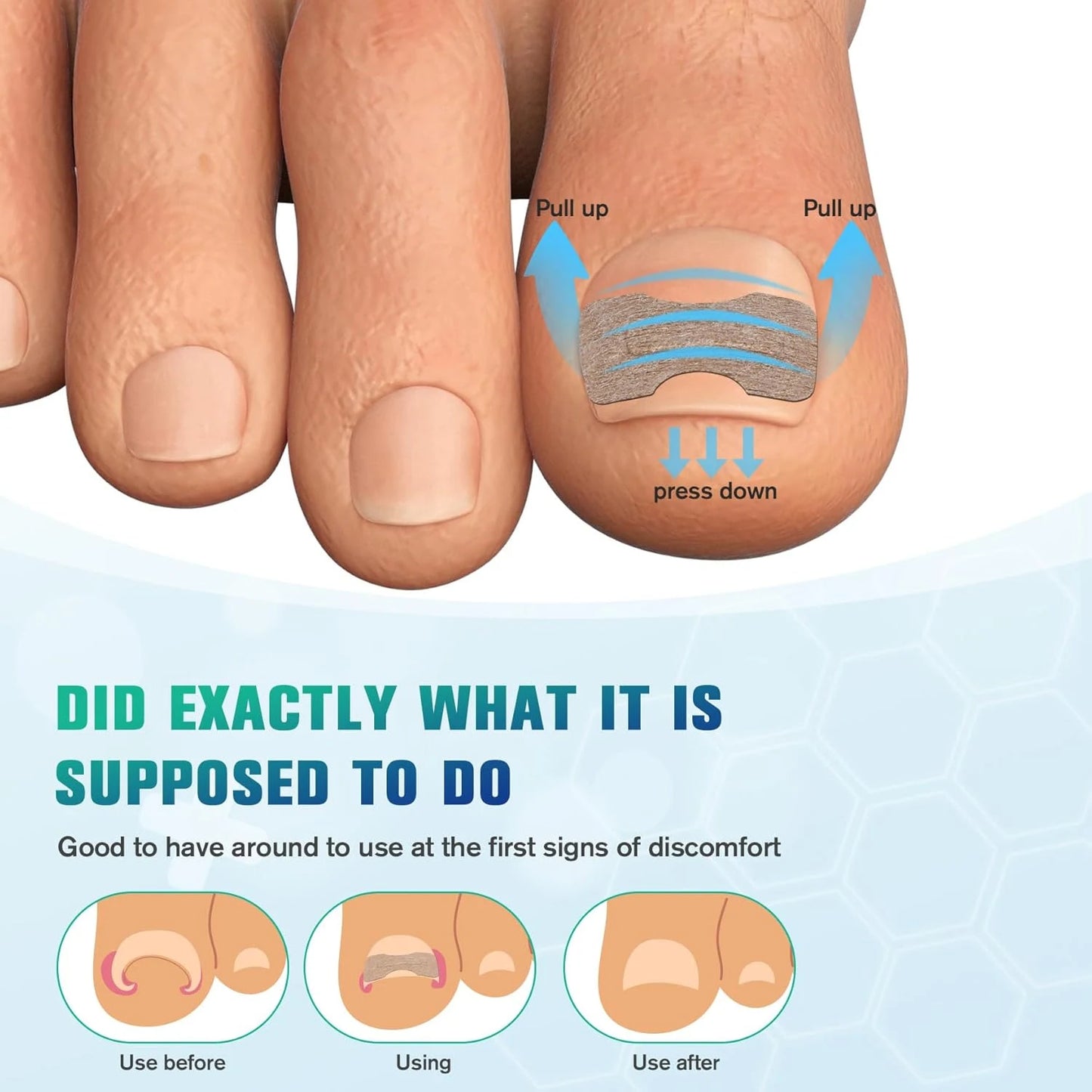 50/100pcs Nail Correction Stickers Ingrown Toenail Corrector Patches Paronychia Treatment Recover Corrector Pedicure Tools