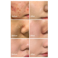 Salicylic Acid Acne Cream – Clear, Soothe & Repair Skin