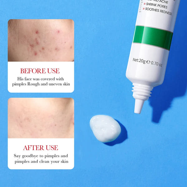 BIOAQUA Salicylic Acid Acne Cream – Clear & Moisturize Skin