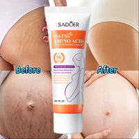 Stretch Mark Repair Cream – Permanent Removal & Firming