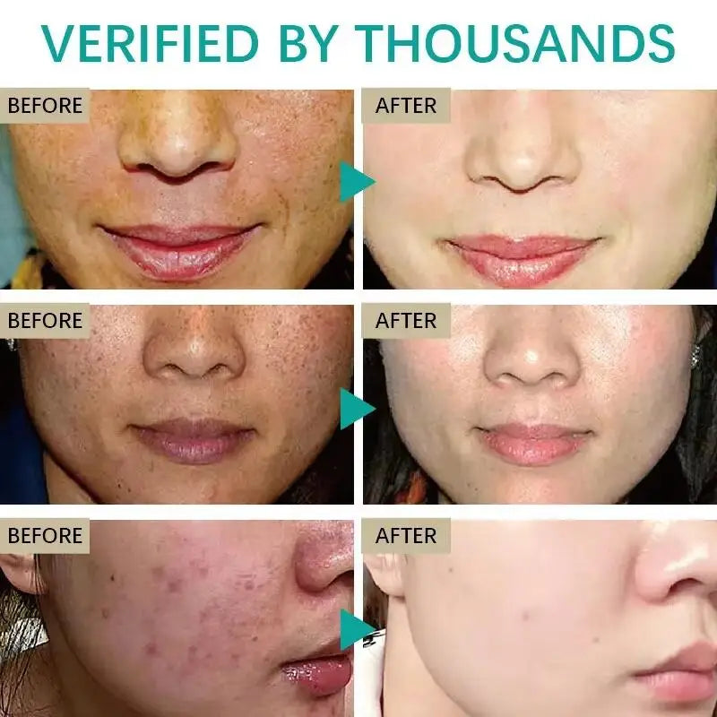 Dark Spot Remover & Whitening Cream – Brighten & Even Skin